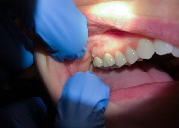 Best Emergency Dental Care for Abscessed Tooth in Saluda, SC