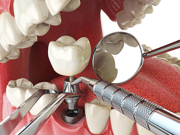 Best Emergency Root Canal Treatment in Saluda, SC
